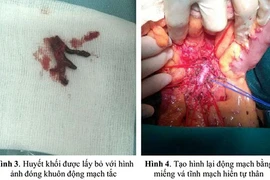 Vá động mạch tránh ruột hoại tử