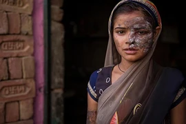 Xót xa bố tạt axit con gái vì dám tố cáo mình