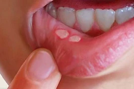 Chữa nhiệt miệng cấp tốc chỉ bằng cách sử dụng nước muối ấm