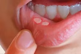 Chữa nhiệt miệng cấp tốc chỉ bằng cách sử dụng nước muối ấm