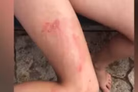 Bé gái bỏng nặng như bị tạt axit vì kem chống nắng