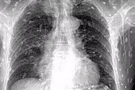 Chỗ nào cũng ngứa, suýt thiệt mạng vì nhiễm sán dây