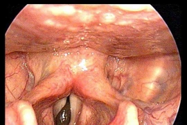 Đỉa bám chặt cổ họng người đàn ông và những vụ khó tin nhưng... có thật