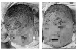 Trẻ 8 tháng tuổi nứt da đầu vì tắm lá: Bác sĩ khuyến cáo gì?