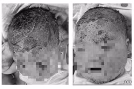 Trẻ 8 tháng tuổi nứt da đầu vì tắm lá: Bác sĩ khuyến cáo gì?