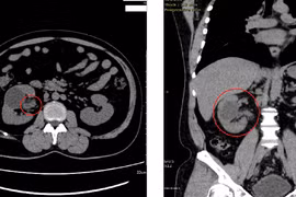 7 năm điều trị nhiễm trùng đường niệu không khỏi bất ngờ phát hiện lao