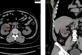 7 năm điều trị nhiễm trùng đường niệu không khỏi bất ngờ phát hiện lao