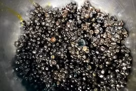 Bác sĩ ngỡ ngàng với hàng nghìn viên sỏi trong túi mật bệnh nhân 