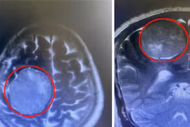 Hai bệnh viện phối hợp cắt khối u não khổng lồ, phức tạp cho người bệnh