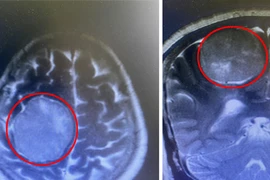 Hai bệnh viện phối hợp cắt khối u não khổng lồ, phức tạp cho người bệnh