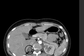 Một lần phẫu thuật lấy cả u nang buồng trứng và u tuyến thượng thận