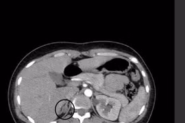 Một lần phẫu thuật lấy cả u nang buồng trứng và u tuyến thượng thận