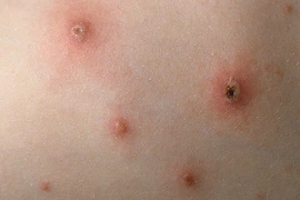 Người lớn mắc thủy đậu dễ suy đa tạng và tử vong