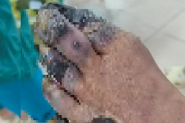 Quấn thuốc đông y trị tê chân, bệnh nhân phải cắt bàn chân vì bỏng