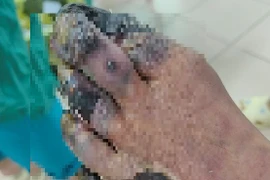 Quấn thuốc đông y trị tê chân, bệnh nhân phải cắt bàn chân vì bỏng