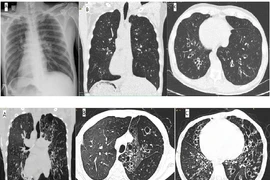 Viêm xoang, viêm phế quản tái diễn cẩn thận hội chứng Kartagener đảo ngược phủ tạng