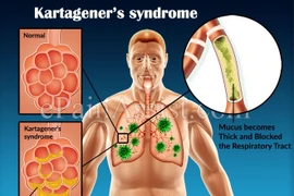 Cách điều trị hội chứng Kartagener gây đảo ngược phủ tạng