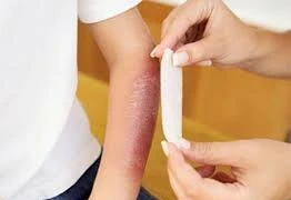 Cách xử trí bỏng đúng để tránh di chứng