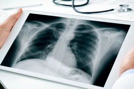 Vụ nhiều công nhân mắc bụi phổi: Biến chứng của bệnh… phòng ngừa như nào?