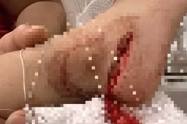 Trẻ 3 tuổi bị dao cứa đứt gân chân do người lớn bất cẩn