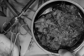 Ăn nhiều mít, phụ nữ 40 tuổi phải mổ tắc ruột