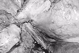 U quái khiến người phụ nữ đi tiểu ra tóc nguy hiểm như thế nào?