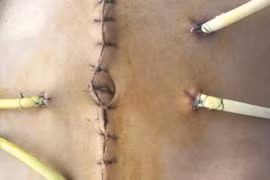 Sống sót thần kỳ khi bị cọc nhồi bê tông ép vỡ tá tràng