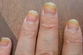 Cách trị hết nấm móng không “tái đi tái lại” cực hiệu quả