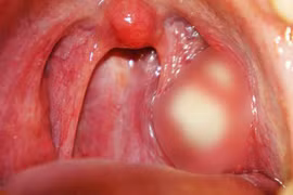 Bạn có thể đang sở hữu “tạo vật” kinh dị này trong họng