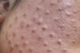 Da nổi u hạt, thâm đỏ sau khi tiêm mesotherapy căng bóng da bằng hoạt chất không rõ nguồn gốc