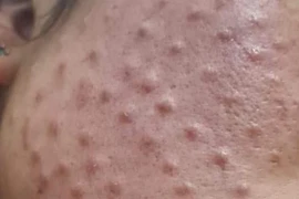 Da nổi u hạt, thâm đỏ sau khi tiêm mesotherapy căng bóng da bằng hoạt chất không rõ nguồn gốc