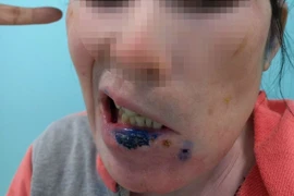 Méo miệng, liệt nửa mặt vì mắc hội chứng hiếm gặp