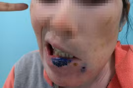 Méo miệng, liệt nửa mặt vì mắc hội chứng hiếm gặp