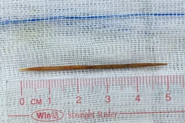 Nội soi gắp tăm xỉa răng dài 5cm cắm sâu vào tá tràng bé trai
