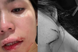 Hằng Du Mục tung hình ảnh đầy vết thương khi bị chồng bạo hành