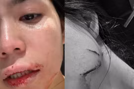 Hằng Du Mục tung hình ảnh đầy vết thương khi bị chồng bạo hành