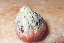 Phân biệt mụn nhọt thông thường với dấu hiệu ung thư da