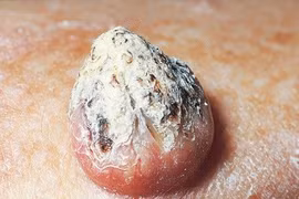Phân biệt mụn nhọt thông thường với dấu hiệu ung thư da