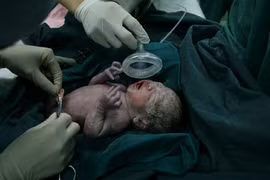 Cận cảnh ca mổ đẻ cho thai phụ sinh 4 gây sốt