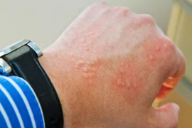 Dấu hiệu cảnh báo bạn có giun ký sinh trong ruột