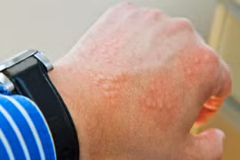 Dấu hiệu cảnh báo bạn có giun ký sinh trong ruột