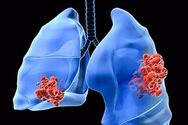 Bệnh ung thư phổi ca sĩ Minh Thuận mắc nguy hiểm thế nào? 