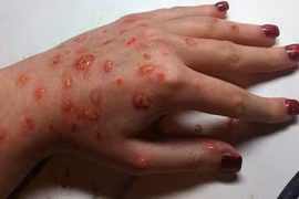 Hình ảnh khủng khiếp bệnh tật sẽ mắc phải nếu không tiêm vacxin