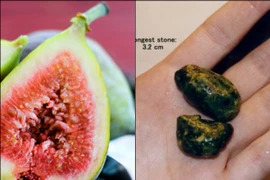 Trị sỏi mật không cần dao kéo