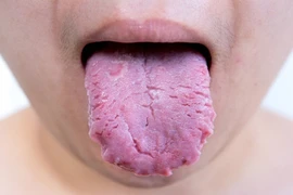 Chuẩn đoán sức khỏe qua tình trạng của lưỡi 