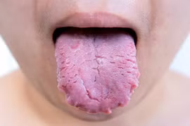 Chuẩn đoán sức khỏe qua tình trạng của lưỡi 