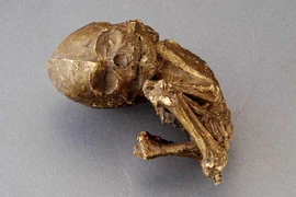 Kỳ dị bào thai hóa đá 40 tuổi trong bụng mẹ 82 tuổi