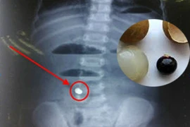 Xót xa cháu bé tử vong vì hóc hạt nhãn 