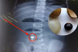 Xót xa cháu bé tử vong vì hóc hạt nhãn 