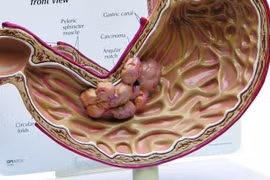  Tiết lộ nguyên nhân đàn ông Việt ung thư dạ dày nhiều nhất